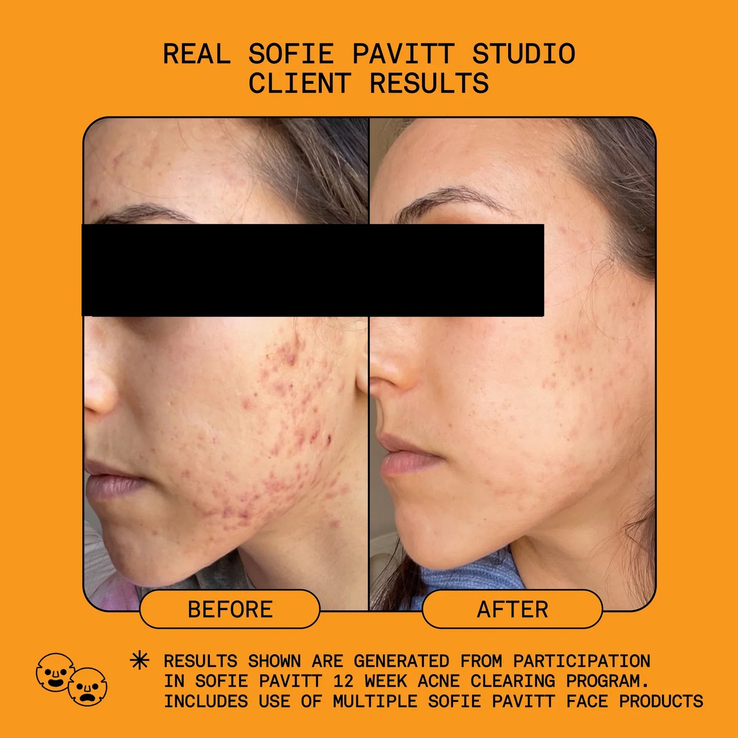 Sofie Pavitt Face Reset 5% Benzoyl Peroxide Acne Treatment